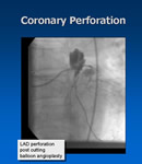 Coronary Perforation