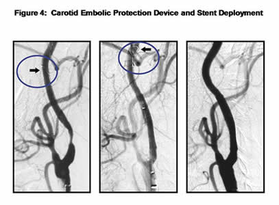 Carotid Embolic Protection Device and Stent Deployment